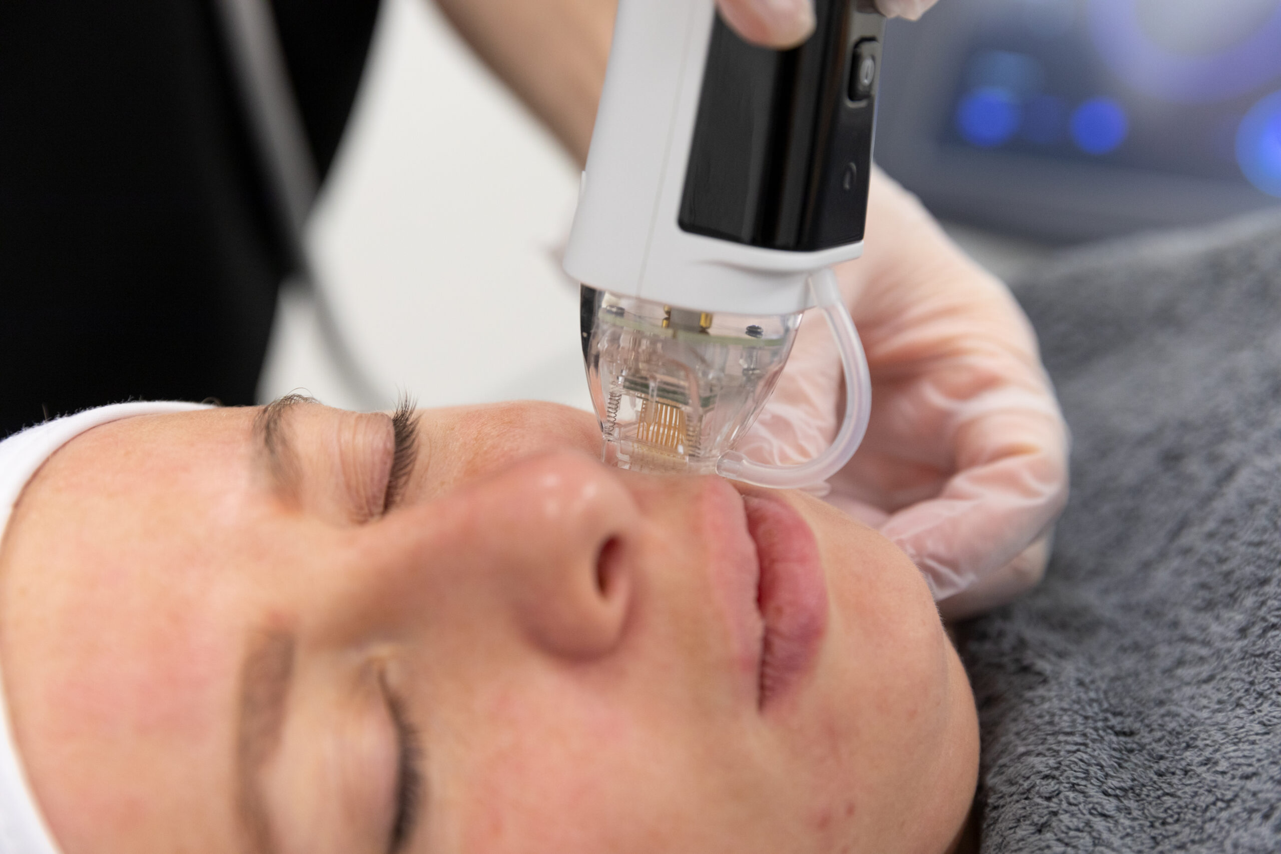 RF-Microneedling-scaled.jpg