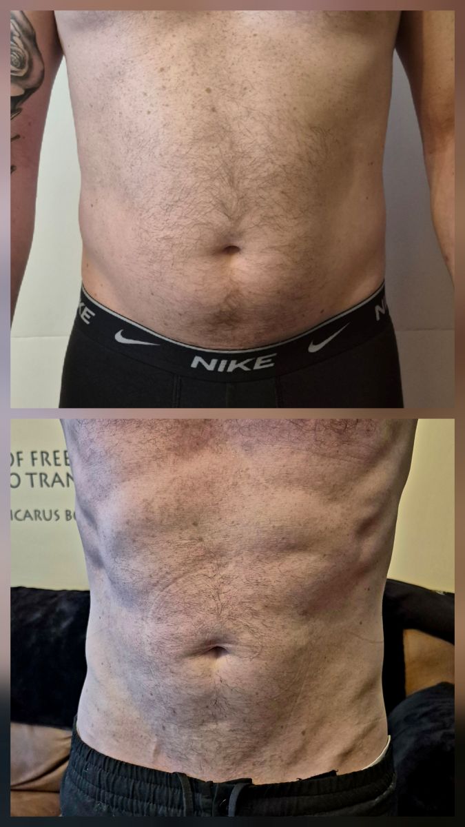 Abdominal muscle activation before and after treatment in North Tyneside